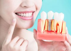 Benefits of Using Dental Implants